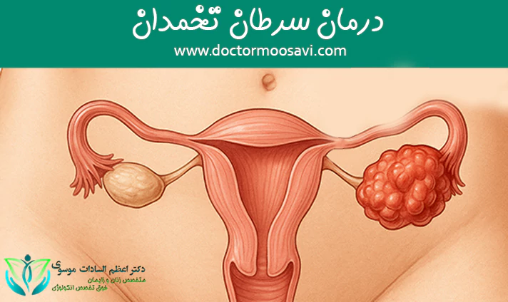 درمان سرطان تخمدان