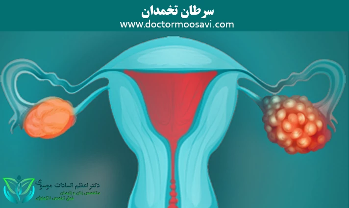 سرطان تخمدان