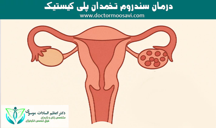 درمان سندروم تخمدان پلی کیستیک